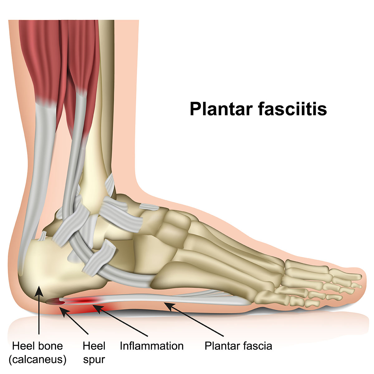 Heel Spur Causes, Symptoms and Natural Treatments - Dr. Axe